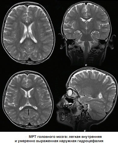 Гидроцефалия головного мозга на МРТ