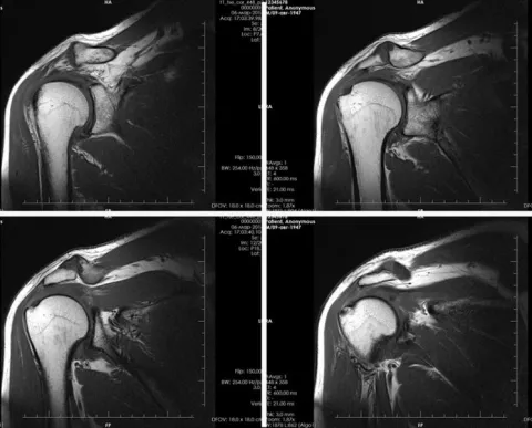 Снимок МРТ плечевого сустава