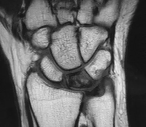 Что показывает МРТ лучезапястного сустава в Чертаново