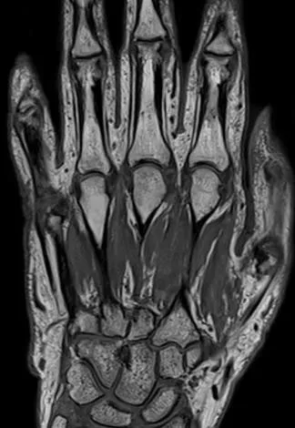 Снимок МРТ кистевого сустава