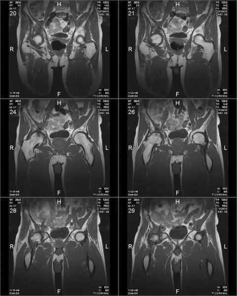 Что показывает МРТ тазобедренного сустава