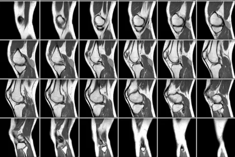 МРТ коленного сустава