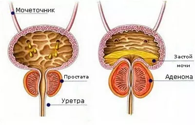 Аденома предстательной железы