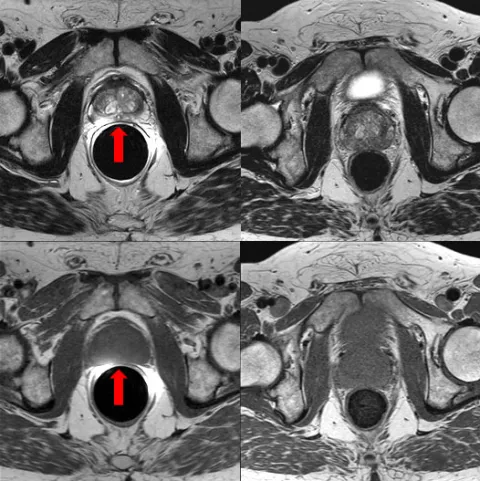 Снимок МРТ предстательной железы