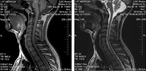 Снимок МРТ шейного отдела позвоночника