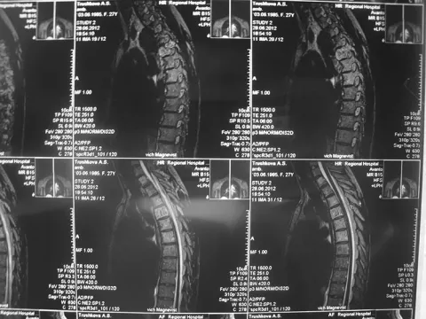 Снимок МРТ грудного отдела позвоночника