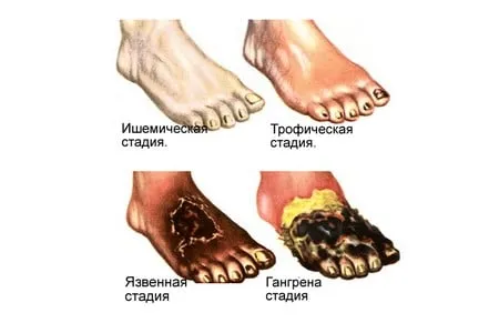 Этапы развития гангрены