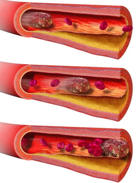Процесс закупорки кровеносных сосудов