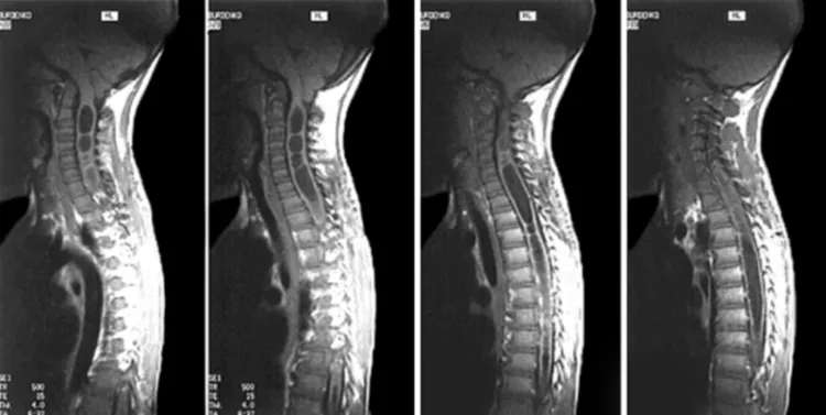 Снимок МРТ при опухолях спинного мозга