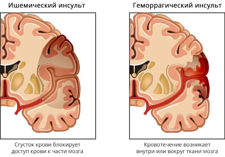 Типы инсульта