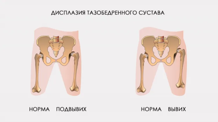 Дисплазия тазобедренных суставов
